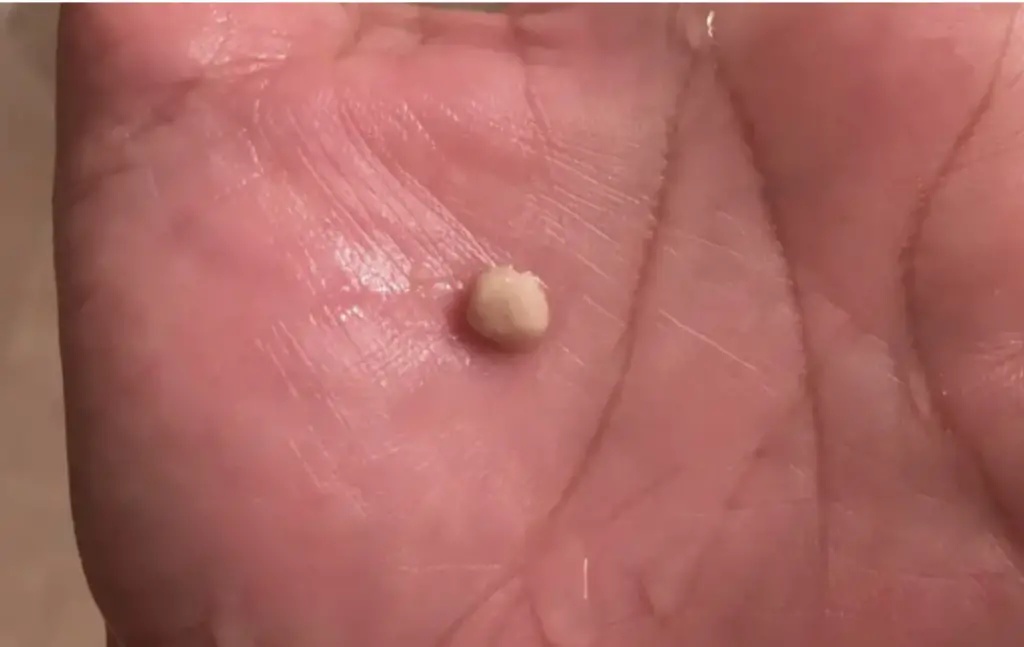 Here’s what you need to know about tonsil stones – the weird pimple-like growths in your throat