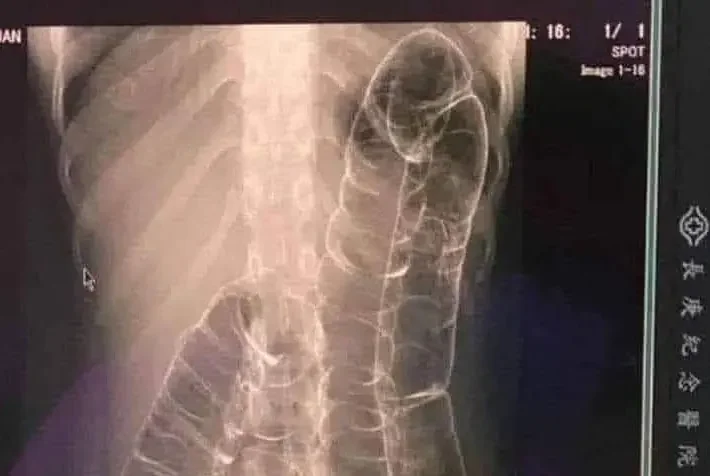 Severe Constipation and Toxic Megacolon: Causes and Solutions